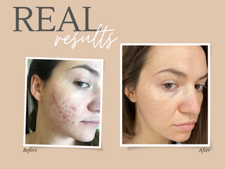 Real Results - Life changing skin transformation!