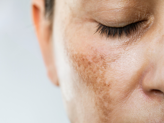 Your hyperpigmentation prevention