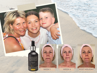 Summer Skin: Prevention vs Cure