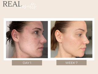 Real Results – Get inspired: Watch your skin changing